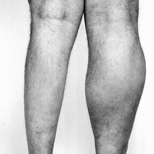 muscle atrophy