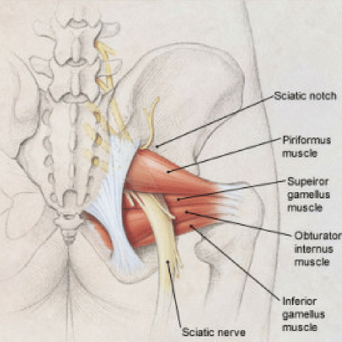 what causes sciatica to flare up